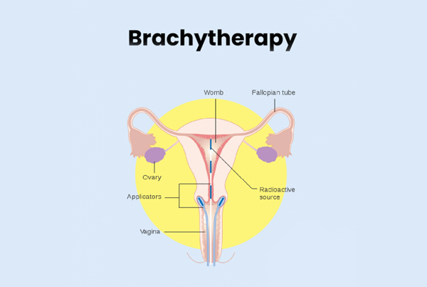 Brachytherapy