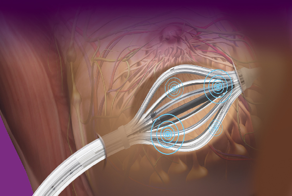 Accelerated Partial Breast Radiation therapy