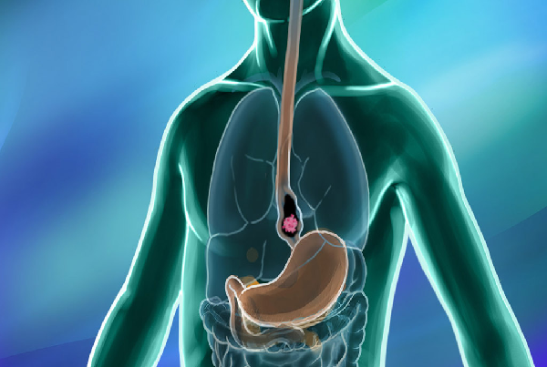 Esophageal Cancer