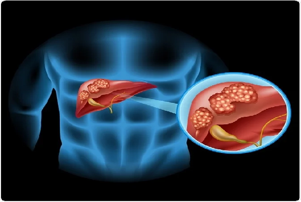 Cholangiocarcinoma