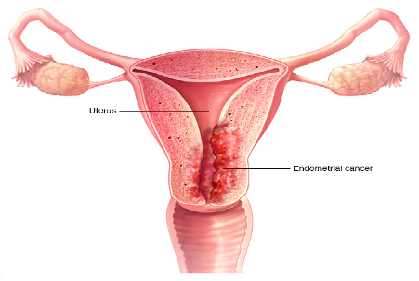 Endometrial Carcinoma